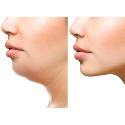 FACE FAT REMOVAL